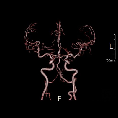 血管の撮影CT画像