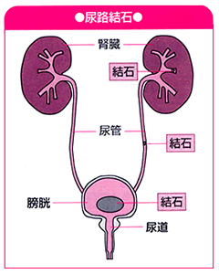 尿路結石