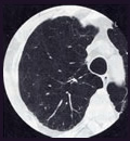 ＣＯＰＤ（肺気腫）の肺