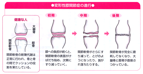 変形性膝関節症の進行