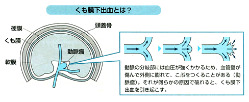 くも膜下出血とは？