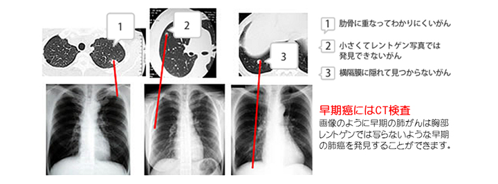 早期がんにはCT検査