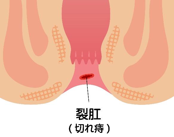 裂肛
