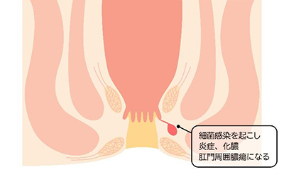 肛門周囲膿瘍