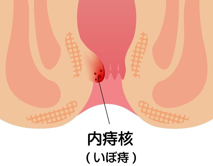 内痔核