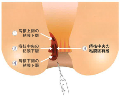 実際の投与方法