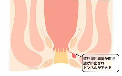 痔ろうの治療法