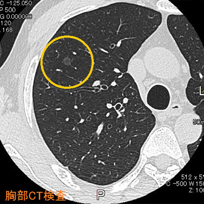 肺CT肺画像