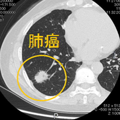 肺CT肺画像