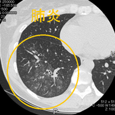 肺CT肺画像