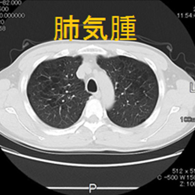 肺CT肺画像