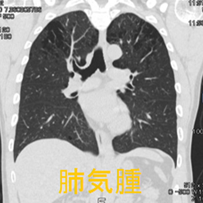 肺CT肺画像