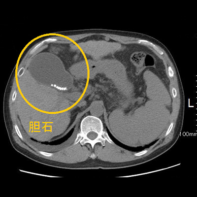 腹部CT画像