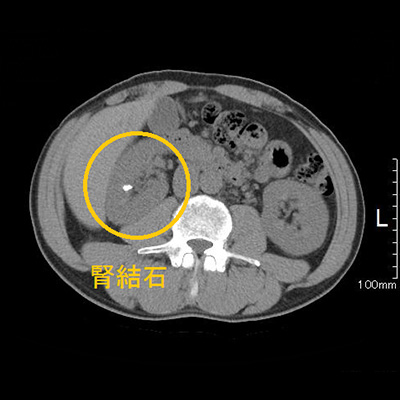 腹部CT画像
