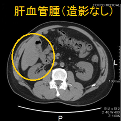 腹部CT画像