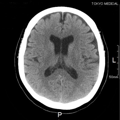 CT頭部画像