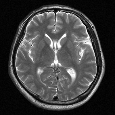 MRI脳画像
