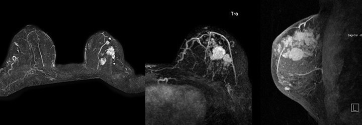乳腺MRI画像