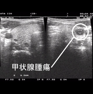 超音波検査