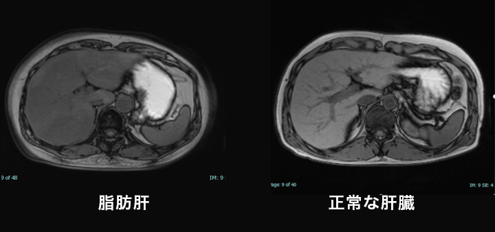 脂肪肝・正常な肝臓