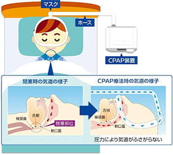 睡眠無呼吸時症候群(SAS)の治療